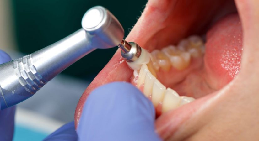 Cleaning-polishing-teeth