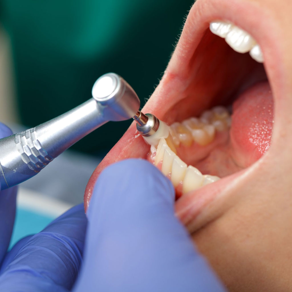 laringe robo Sábana Limpieza y Pulido - Family Dental Center